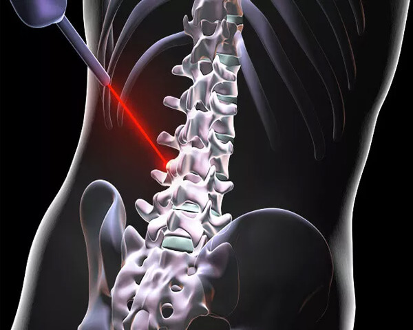 Spine Surgery Hill Candy Hospital Bokaro
